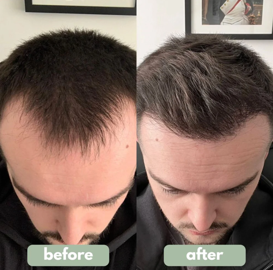 Regenix™ Hair Recovery for Men